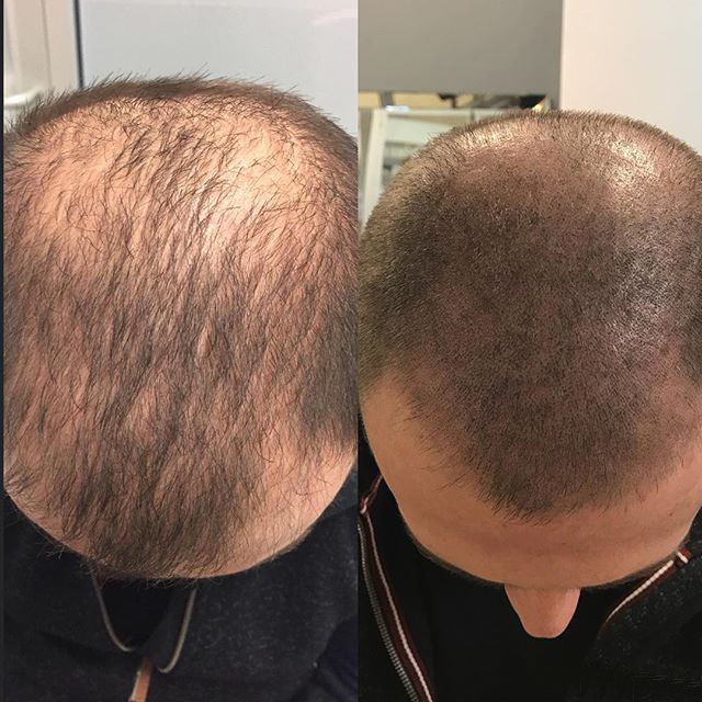 Scalp Micro Pigmentation (SMP)